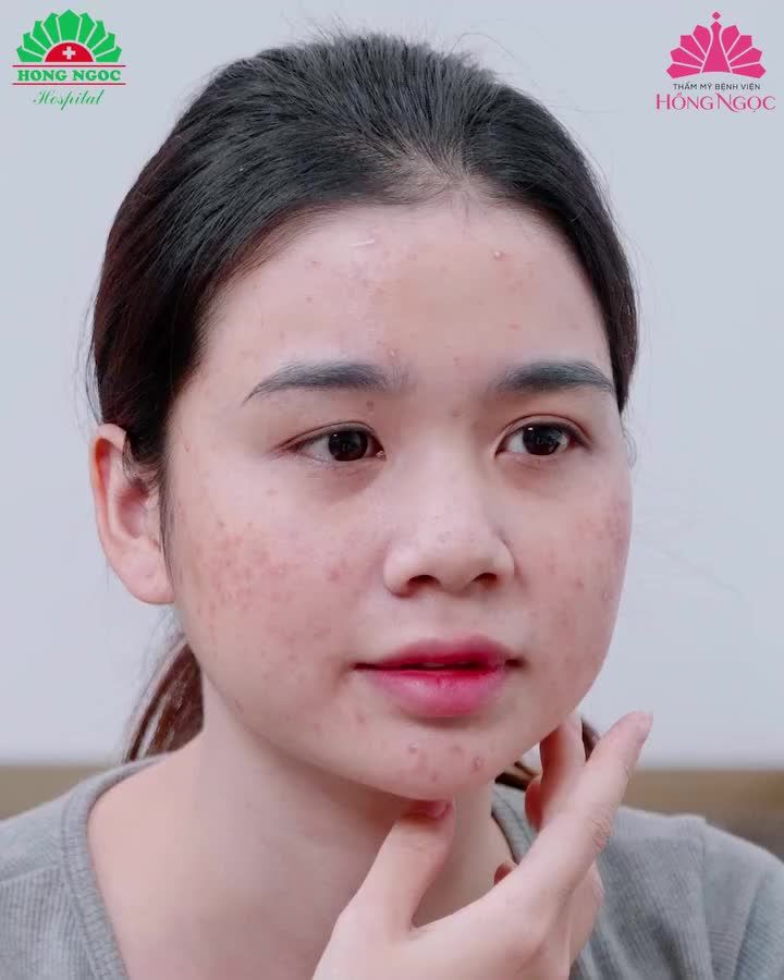 MỤN MỌC KÍN MẶT, CÀNG NGÀY CÀNG NHIỀU STRESS VÌ TRỊ MỤN MÃI KHÔNG KHỎI
