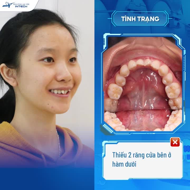 20 NĂM TỰ TI VÌ HÀM RĂNG 9-6-3-0, 9X QUYẾT TÌM NIỀNG RĂNG ĐỂ “ĐỔI VẬN”