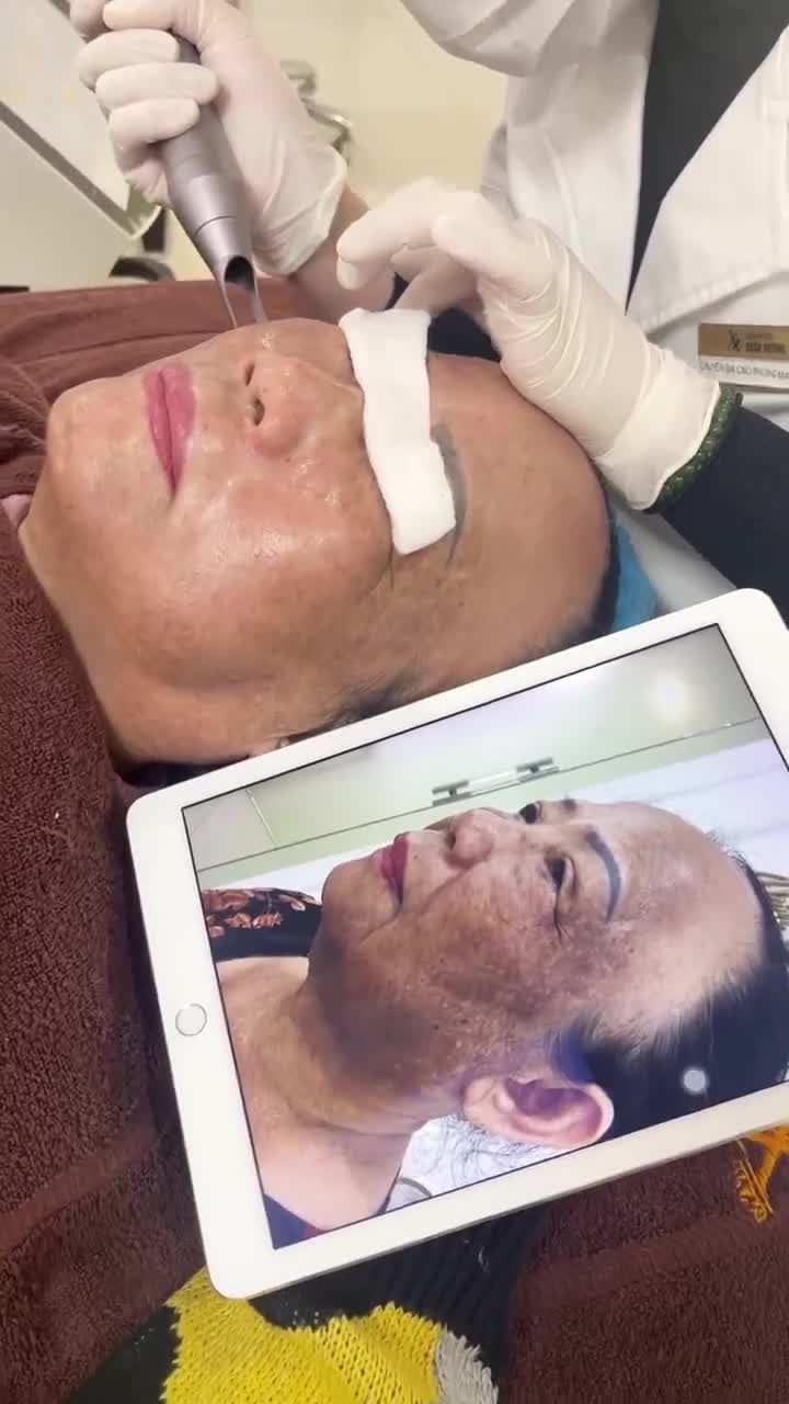 Sốc nám mảng đen kín mặt  Điều trị chuẩn phác đồ cá nhân hóa cùng bác sĩ VTM Xuân Hương