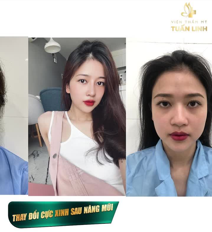 XEM CLIP ĐỂ THẤY SỨC MẠNH CỦA MỘT CHIẾC MŨI ĐẸP SẼ THAY ĐỔI GƯƠNG MẶT NHƯ THẾ NÀO?