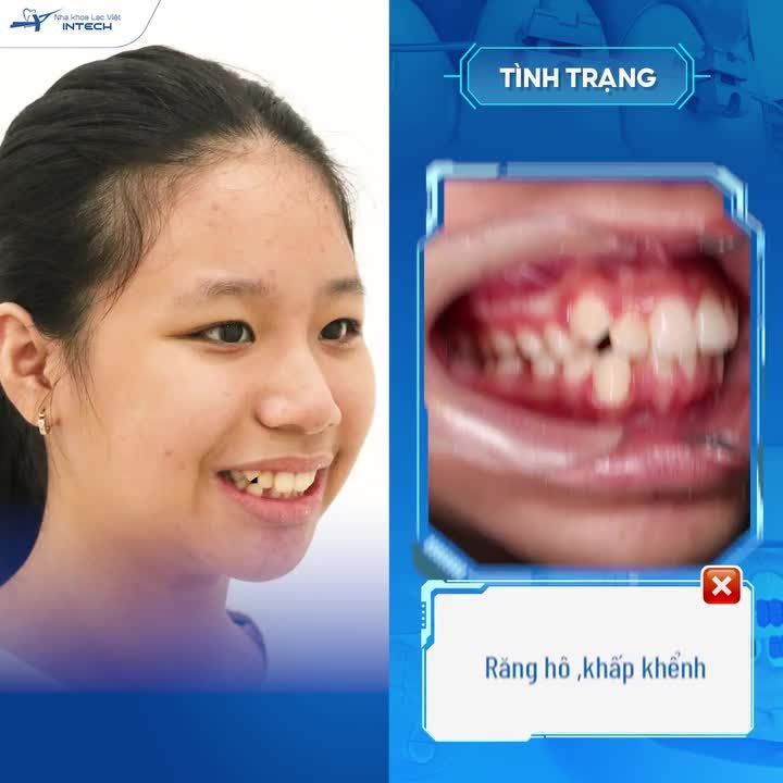 NGỠ NGÀNG TRƯỚC KẾT QUẢ NIỀNG RĂNG CỦA NỮ SINH 14 TUỔI
