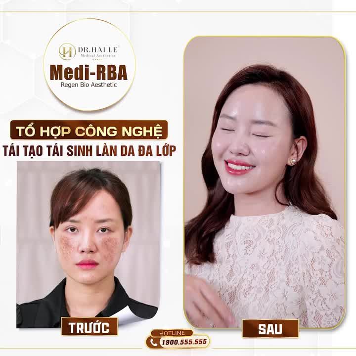 Trước khi thực hiện: Mụn thâm, mụn đỏ lẫn lộn, nền da không đều màu, tăng, giảm sắc tố.
