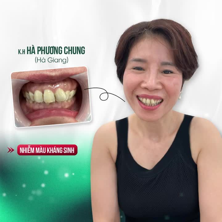 THẨM MỸ 22 RĂNG SỨ CAO CẤP LÀ LỰA CHỌN CỦA CHỊ GÁI HÀ GIANG KHI ĐẾN NHA KHOA GIA ĐÌNH
