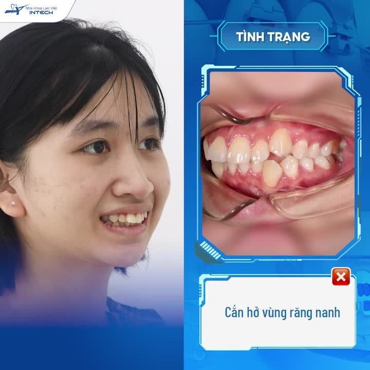 NỮ SINH 2K THAY ĐỔI NGOẠN MỤC SAU 2 NĂM NIỀNG RĂNG!