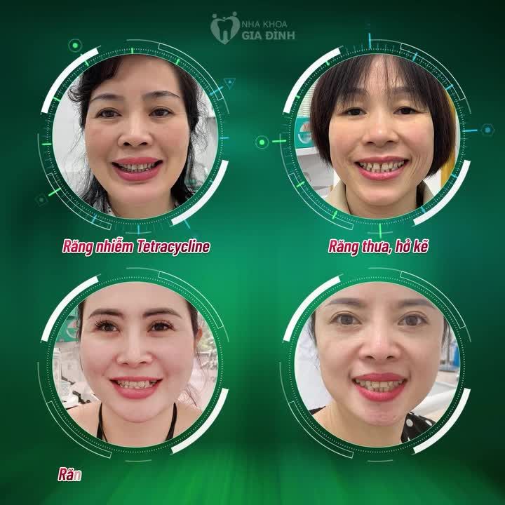MUÔN VÀN KHUYẾT ĐIỂM NỤ CƯỜI KHẮC PHỤC TRIỆT ĐỂ CHỈ SAU 2 LẦN HẸN