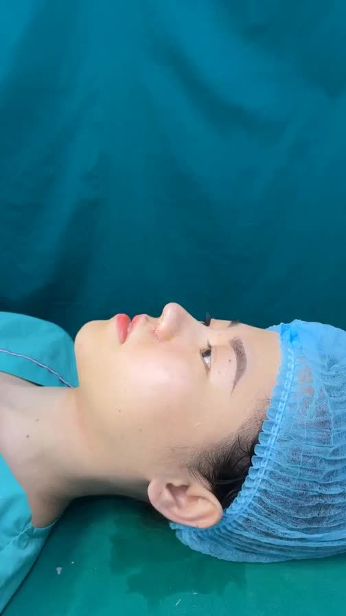 Case mũi bọc sụn vừa hoàn thành
