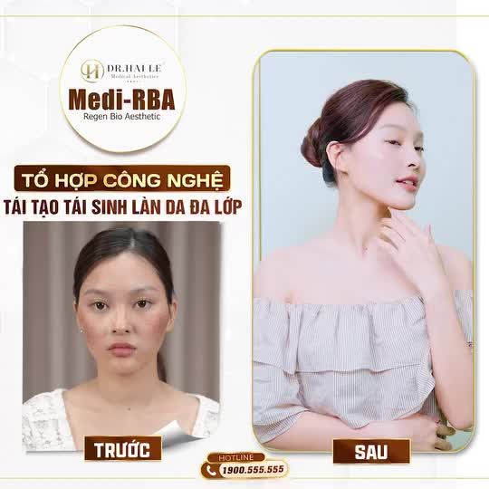 Mỗi vị khách hàng khi đến Dr.Hải Lê đều gặp phải những vấn đề về da khác nhau: khuyết điểm dày đặc, mụn thâm chi chít, lỗ chân lông to, nám và tàn nhang không phải là ngoại lệ.