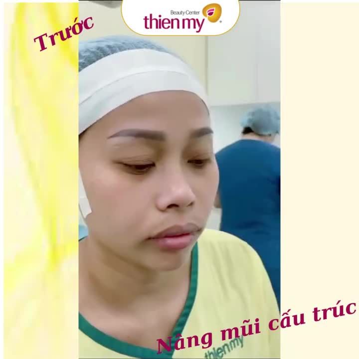 NGẮM NHÌN FORM DÁNG MŨI SIÊU XINH KHÁCH HÀNG TẠI THIỆN MỸ