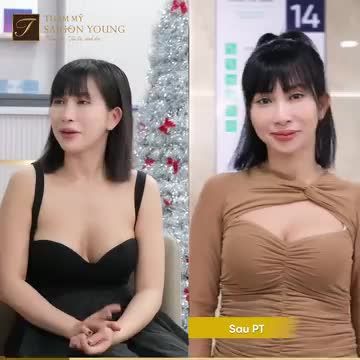 Hành trình nâng ngực lần 2 của khách hàng.