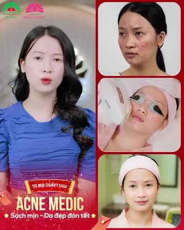 Thoát khỏi cơn ác mộng mụn đeo bám nhờ phác đồ TRỊ MỤN CHUẨN Y KHOA