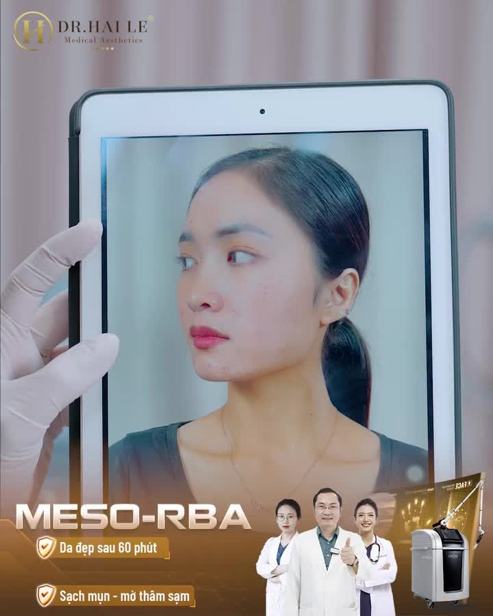 Chị Thanh Huyền đã từng tiê.m Meso hỏng, trước khi đến Dr.Hải Lê làn da của chị có rất nhiều tổn thương, đồng thời 2 điểm bên gò má là những vết thâm và bị ửng đỏ khi sử dụng những hoạt chất Meso không được đảm bảo.