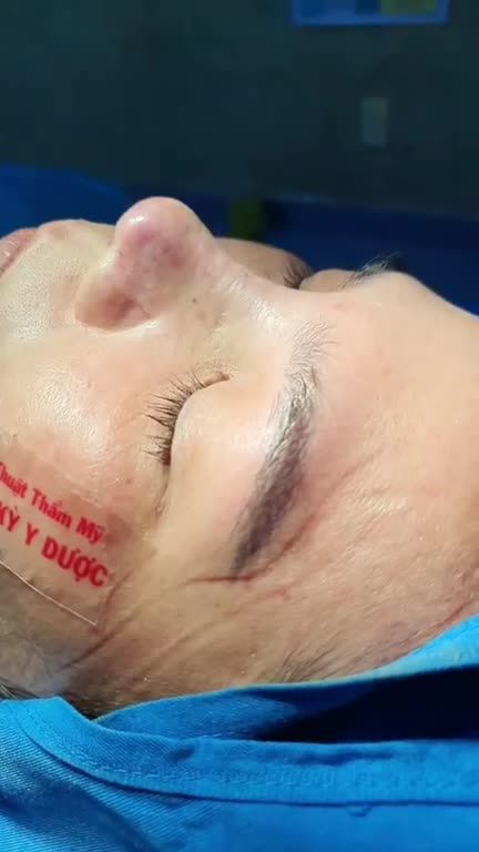 NÂNG MŨI BÁC SĨ KỲ CÓ GÌ ĐẶC BIỆT