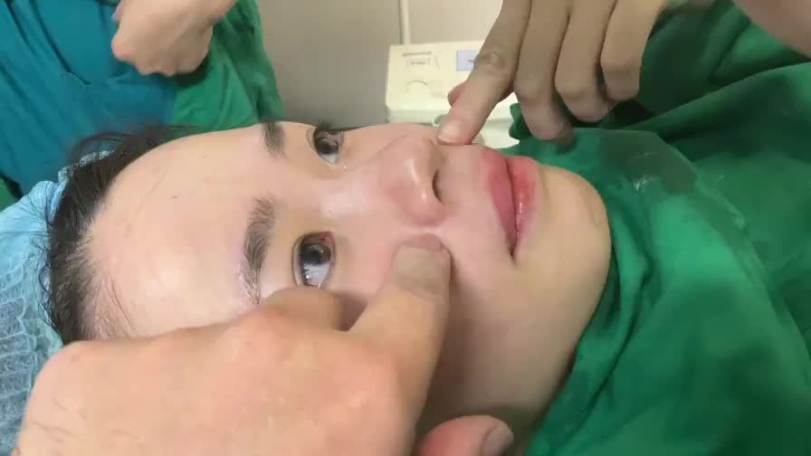 Dr Vương thực hiện “Độn rãnh mũi má” cho bạn gái Việt kiều từ Nhật Bổn zề …