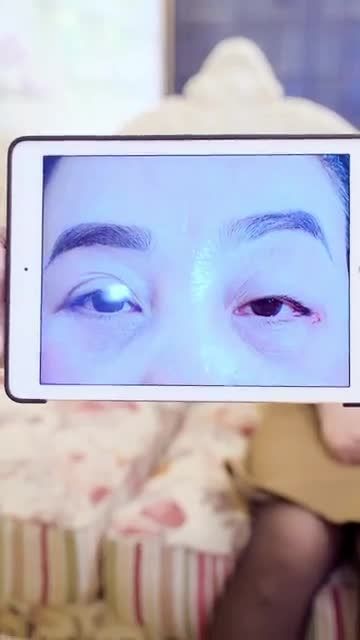 Mí lỗi hỏng đứt cơ nâng mi sau 7 ngày thực hiện trông sẽ như thế nào? Cả nhà cùng đón xem