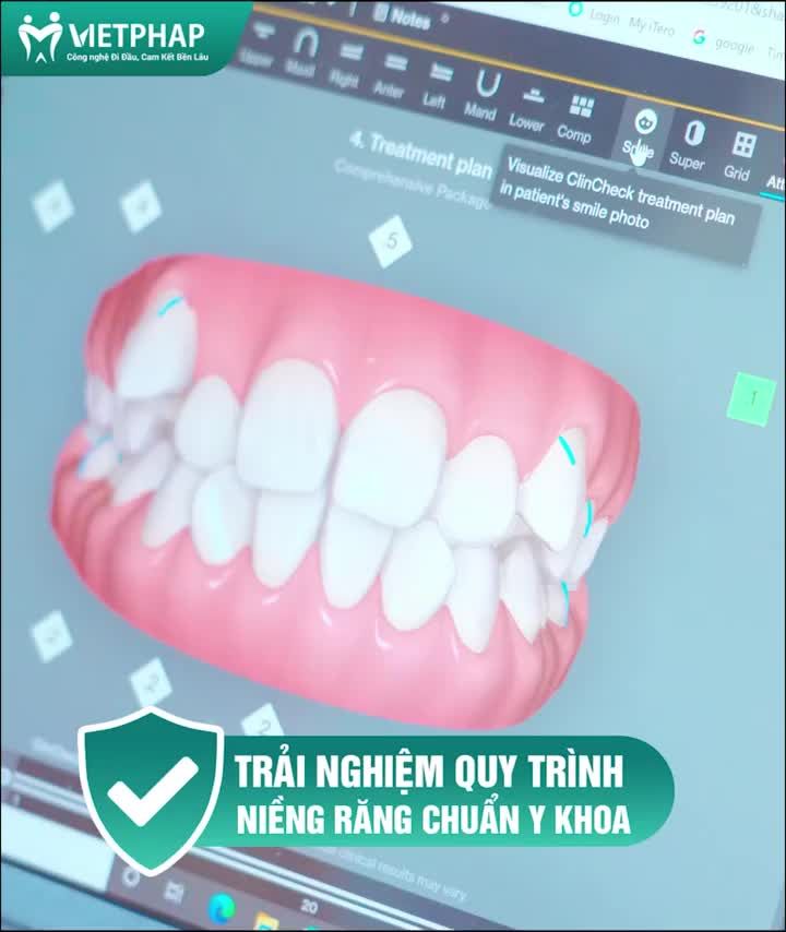 THỜI ĐIỂM VÀNG NIỀNG INVISALIGN ĐÓN TẾT - THẨM MỸ TUYỆT ĐỐI NIỀNG NHƯ KHÔNG NIỀNG