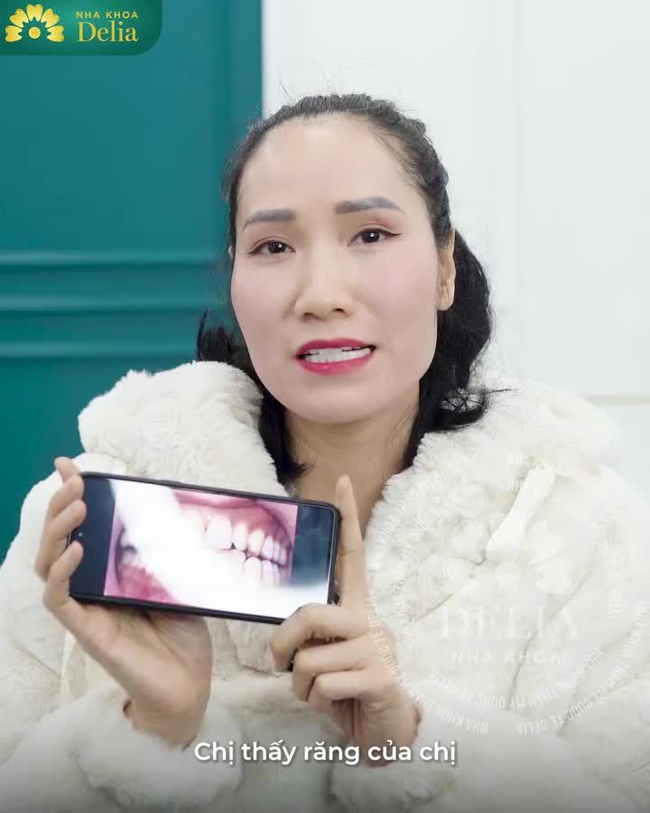 Cùng lắng nghe những cảm nhận của chị Hà về trải nghiệm làm răng sứ tại Delia qua video dưới đây nhé!