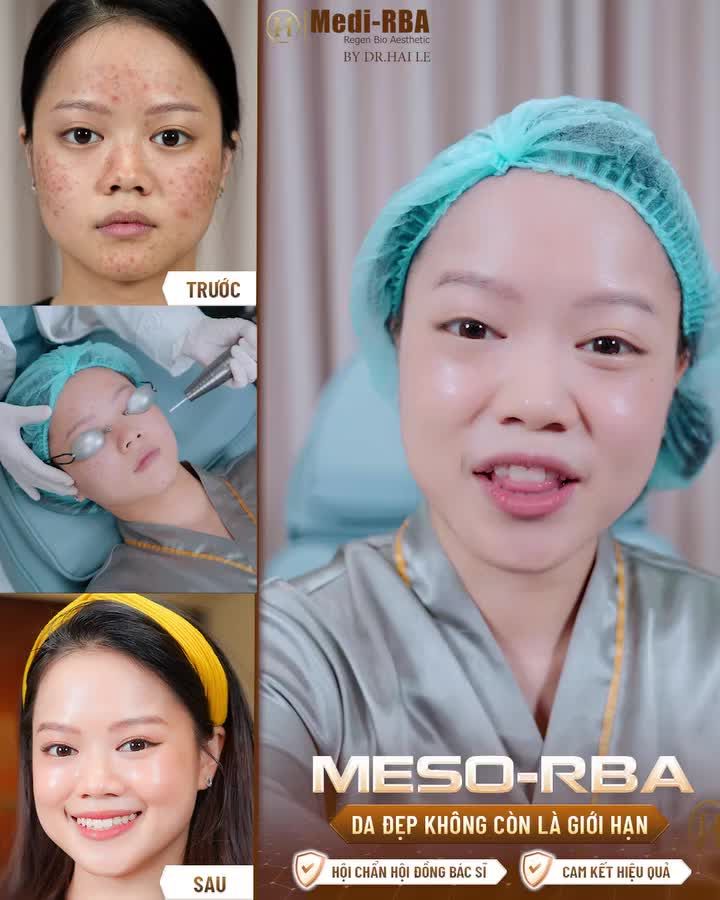 CẢM NHẬN CHÂN THỰC CỦA CÔ NÀNG MAI PHƯƠNG SAU 3 BUỔI THỰC HIỆN MESO-RBA TẠI DR.HẢI LÊ