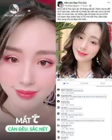 Feedback khách hàng cắt mí