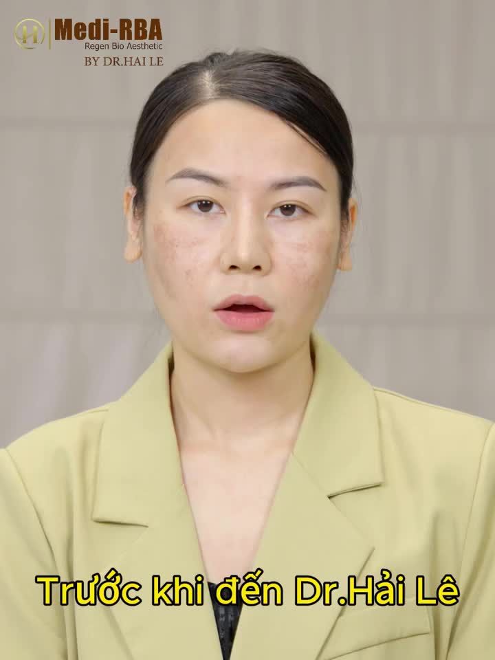 Trước khi đến Dr. Hải Lê, chị Minh Quyên bị nám dày đặc, tình trạng này không hề thuyên giảm đặc biệt là sau khi chị sinh con.