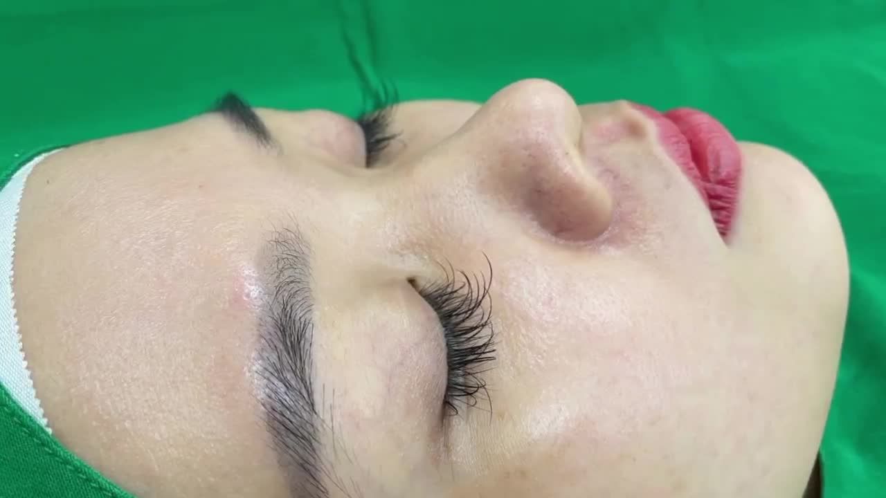 Ưu điểm khi nâng mũi tại Thiện Mỹ: