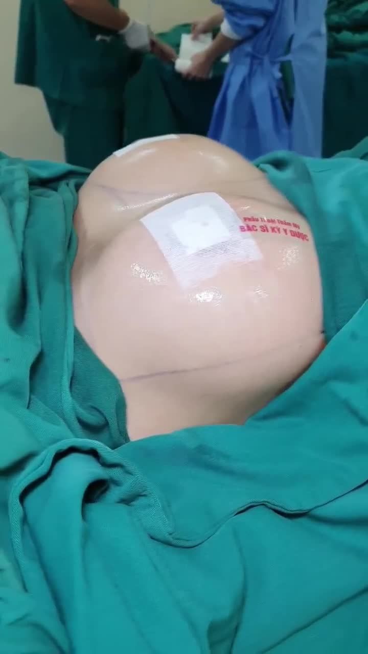Bác sĩ Kỳ Y Dược đã giúp bạn khách lấy lại tự tin với phẫu thuật Treo sa trễ + Nâng ngực với dòng túi MOTIVA NANO đồng size 335cc.