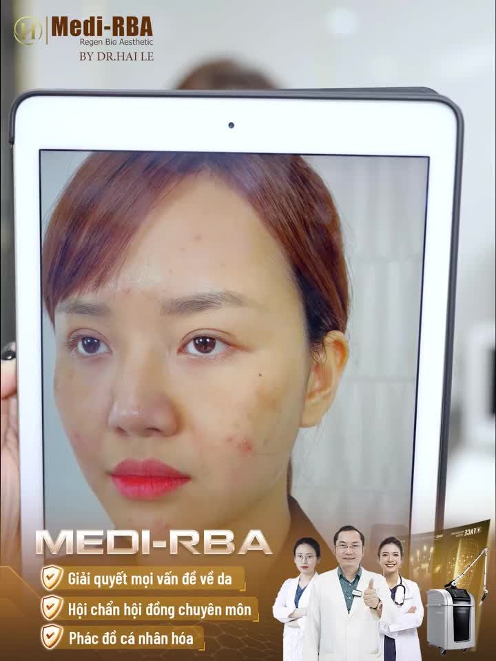 Chị Phương thảo làn da nhiều mụn, lỗ chân lông to. Từ khi chị đi tiêm Meso tại một cơ sở không uy tín thì còn gặp phải tình trạng kích ứng, mẩn đỏ.