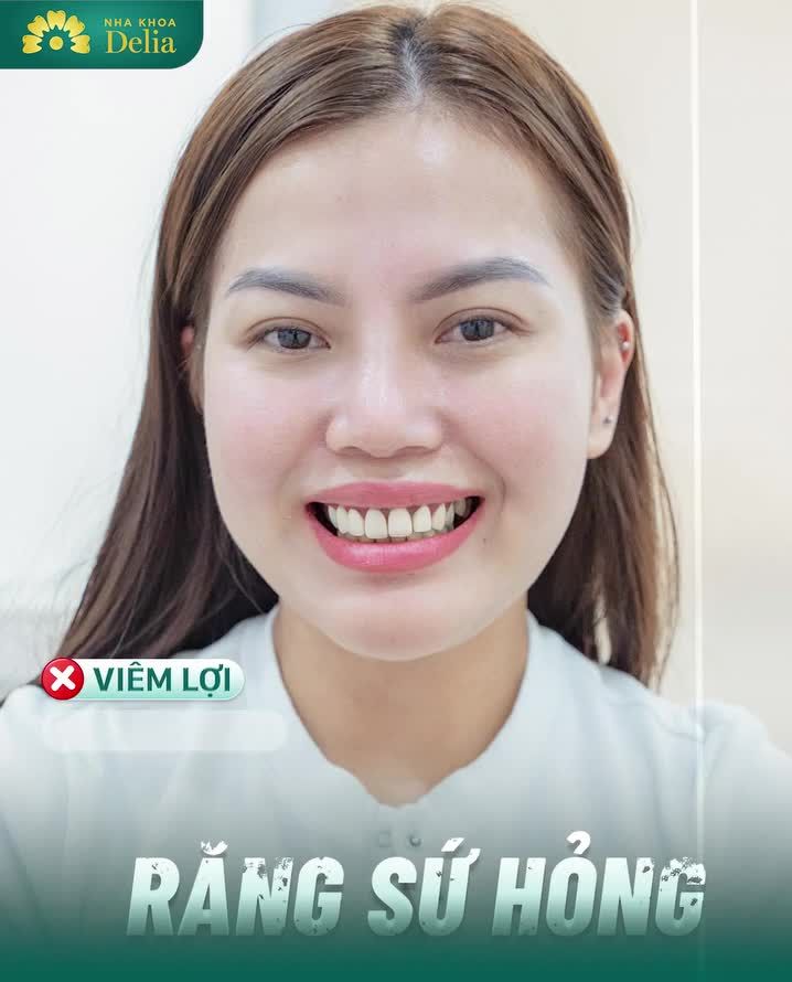 Quy trình PHỤC HÌNH SỨ HỎNG cho chị Thy Nguyễn