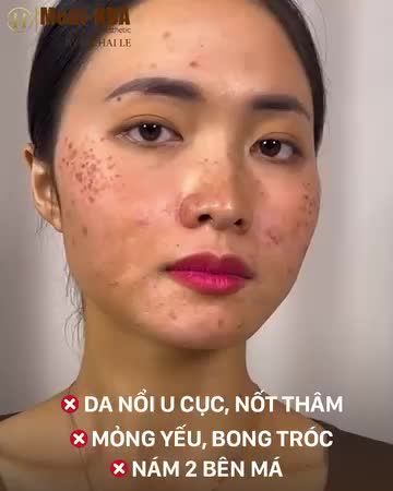 Da nổi u cục, nốt thâm Nền da mỏng yếu, bong tróc Nám lan 2 bên má. Đó là tình trạng của nhiều chị em gần đây khi đến làm đẹp da với Meso tại những cơ sở không uy tín