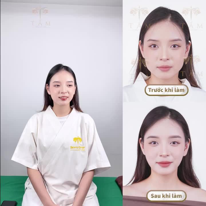 CA VLINE PERFECT QUAY LẠI TÁI KHÁM SAU 2 THÁNG