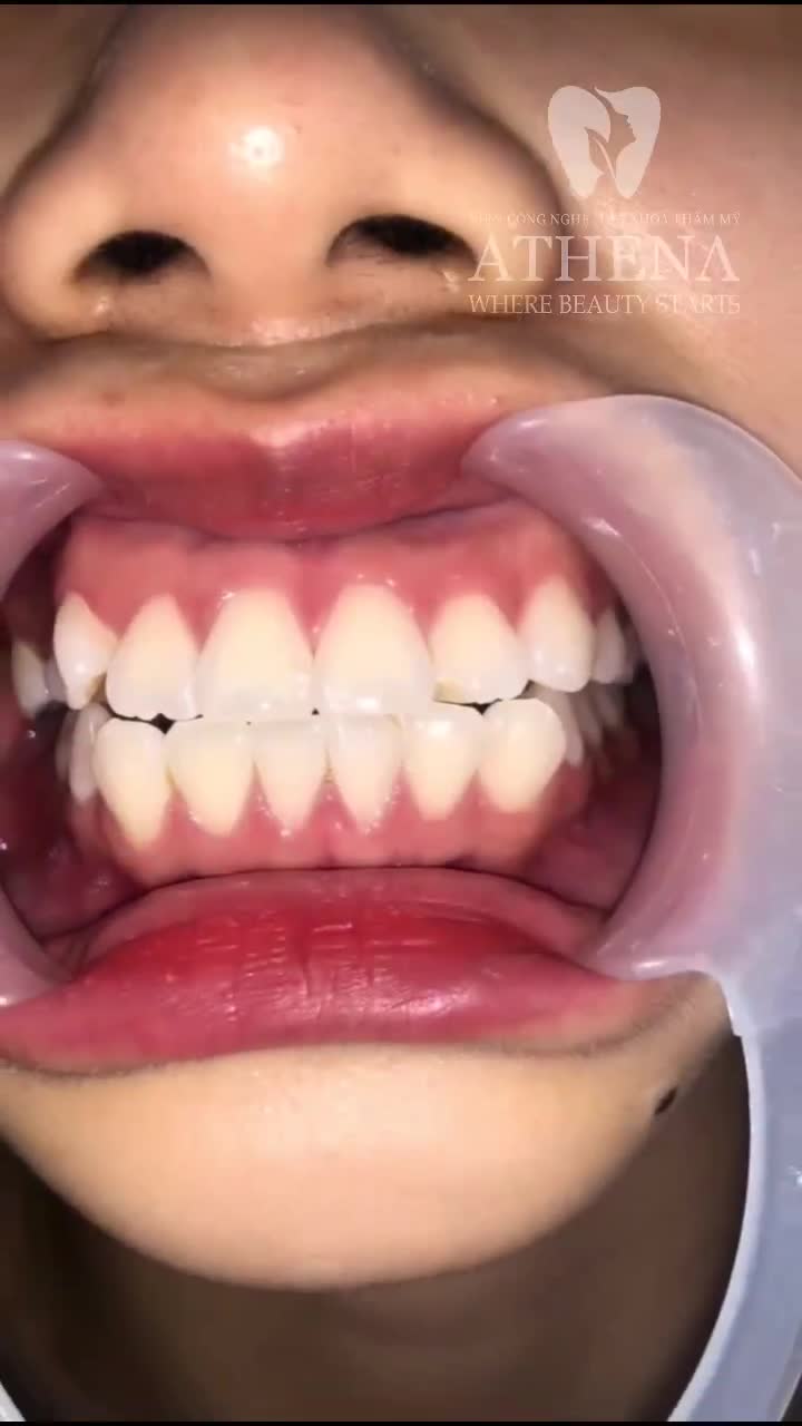Chúc mừng Huỳnh Thị Ngọc Giàu - Những Nụ Cười Tươi Sáng Sau Tháo Niềng!