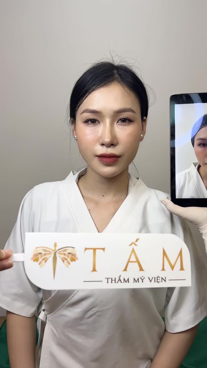 Khuôn mặt hoàn hảo với Filler Má - Môi - Cằm tại Tấm đẹp ngay chỉ sau 30 phút