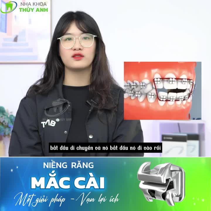 THAY ĐỔI LỚN CHỈ SAU 1.5 NĂM NIỀNG RĂNG HÔ TẠI NHA KHOA THUỲ ANH