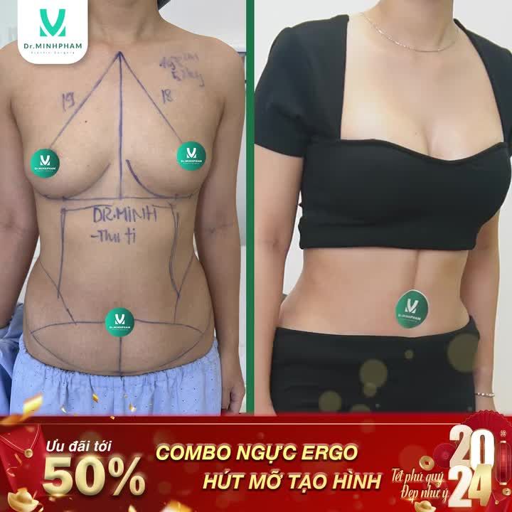 KIẾN TẠO BỤNG ĐẸP - NGỰC XINH ĐÓN TẾT