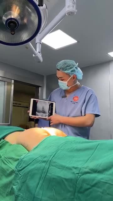 KẾT QUẢ CA CẤY MỠ V3 RẤT ĐẸP