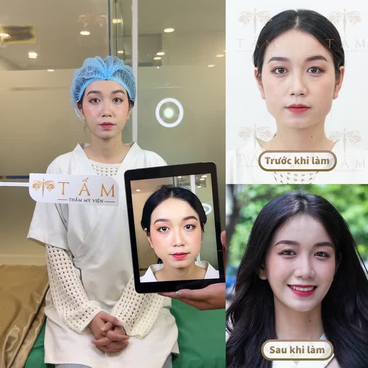 Chị khách quay lại tái khám sau 2 tháng sử dụng dịch vụ Vline Perfect liệu trình lần 2 tại Thẩm mỹ viện #Tấm.