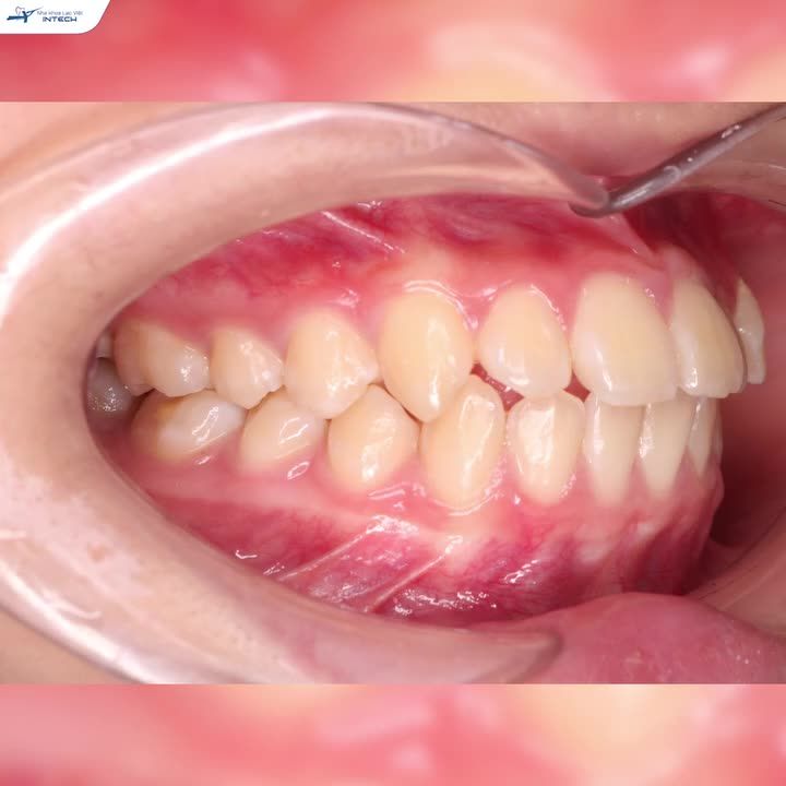 LUÔN ĐEO KHẨU TRANG VÌ NGẠI “XẤU”, NỮ SINH LỘT XÁC NGỠ NGÀNG SAU NIỀNG RĂNG!
