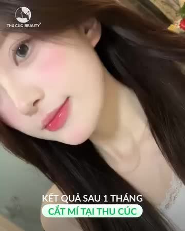 Kết quả cắt mí sau 1 tháng tại Thu Cúc