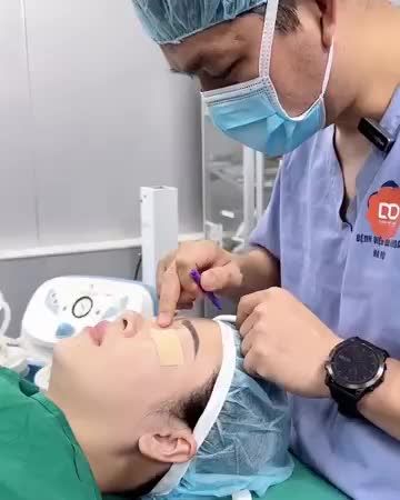 ĐỨNG HÌNH 5S - Visual XINH NGẤT NGÂY sau Nâng mũi Perfect Dform.