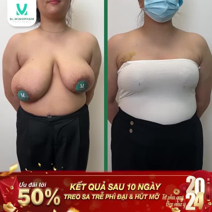 HẾT “PHÌ ĐẠI” NG.ỰC LẠI SEXY Thu Nhỏ Ngực Phì Đại – “cứu tinh” cho V1 “quá khổ”