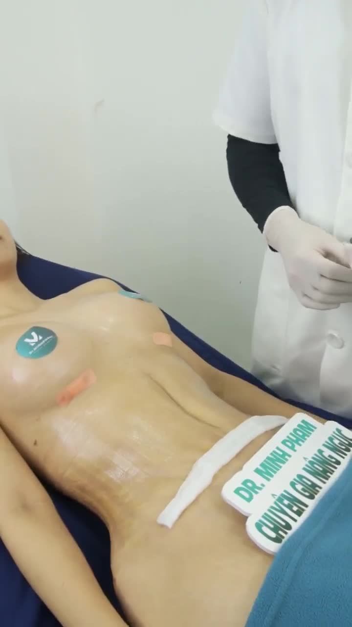 Cả nhà cùng nghe bs Minh chia sẻ về trường hợp của chị khách hàng thực hiện combo nâng cấp V1 + hút mỡ tạo hình bụng để thấy được sự thay đổi hoàn hảo sau khi phẫu thuật nha cả nhà!