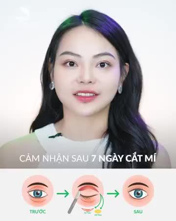 Cảm nhận sau 7 ngày cắt mí tại Thu Cúc
