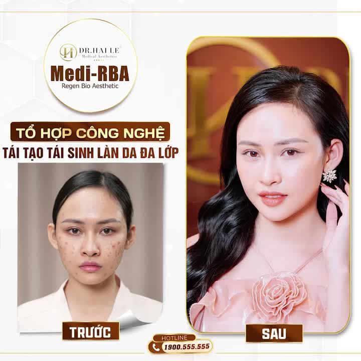 Khách hàng xinh đẹp sau khi thực hiện tổ hợp Medi-RBA là có thật