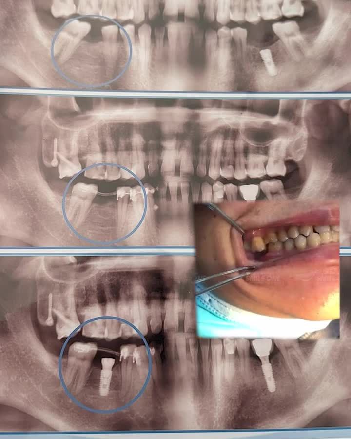 Trồng răng implant, phục hình răng mất, ăn nhai như răng thật!