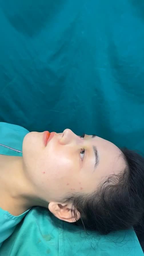 Case mũi bọc sụn 15tr vừa hoàn thành