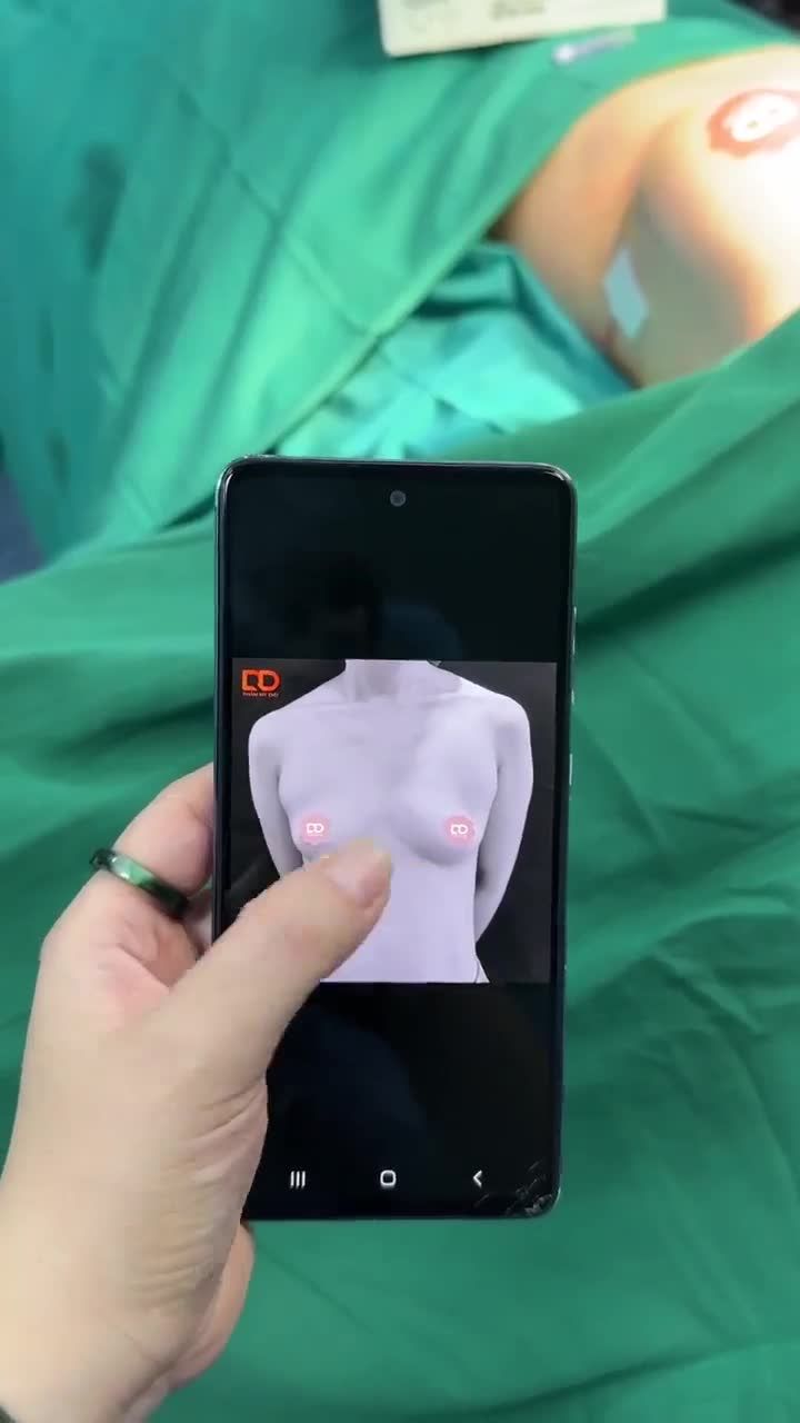 KẾT QUẢ CA NÂNG NGỰC RẤT ĐẸP
