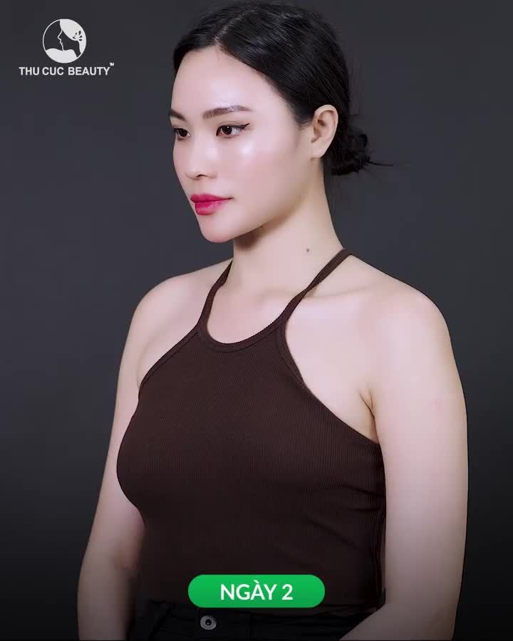 Vòng 1 cực cháy sau nâng ngực tại Thu Cúc