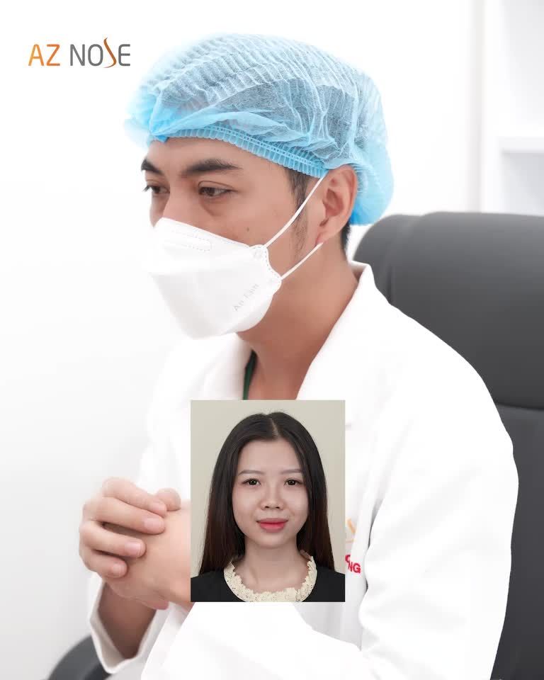 Sinh viên từng tiêm filler thay đổi thế nào sau 1 tháng nâng mũi?
