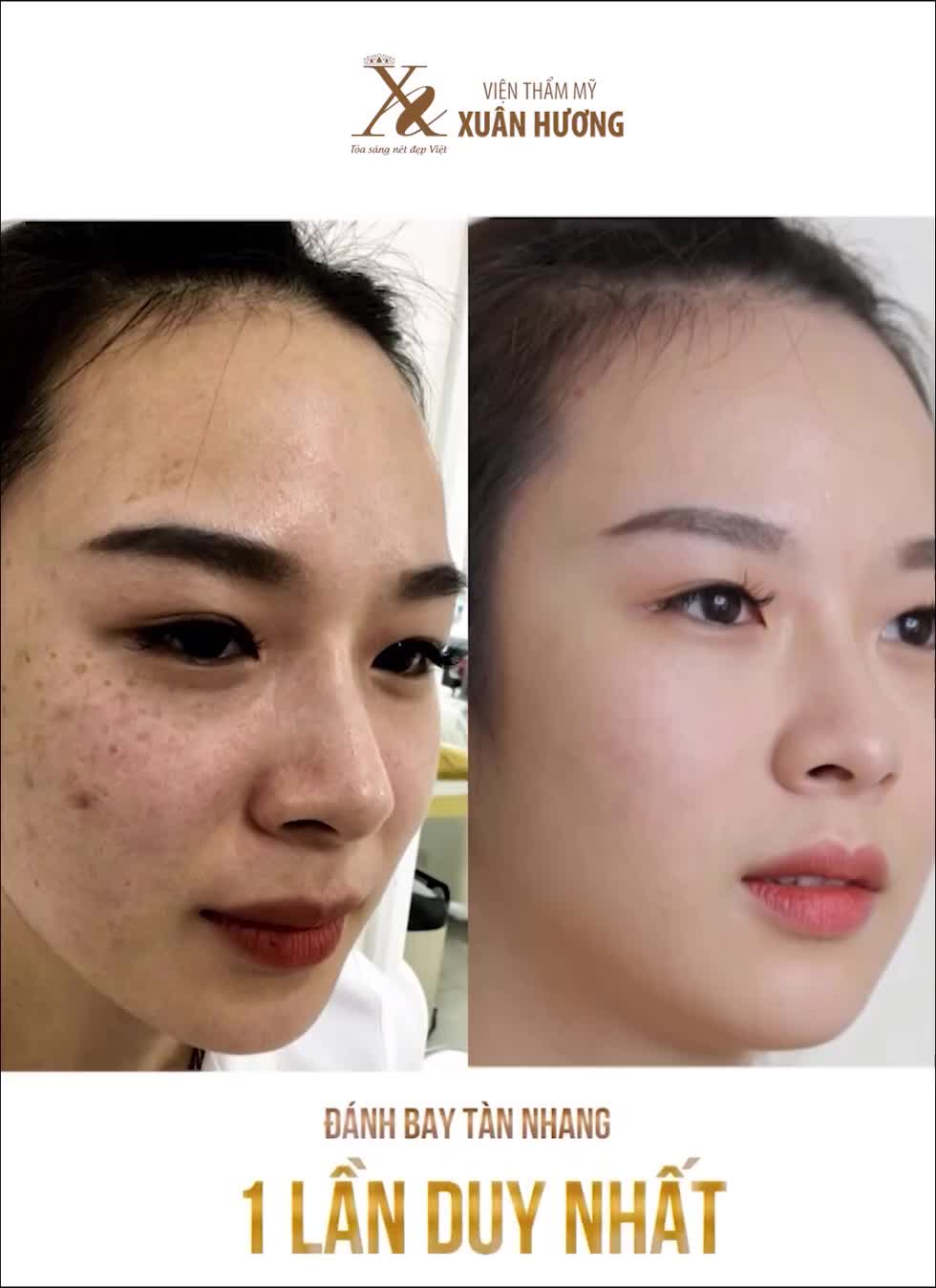 Nếu nám tàn nhang chính là nỗi lo của bạn thì hãy để VTM Xuân Hương "giải quyết"