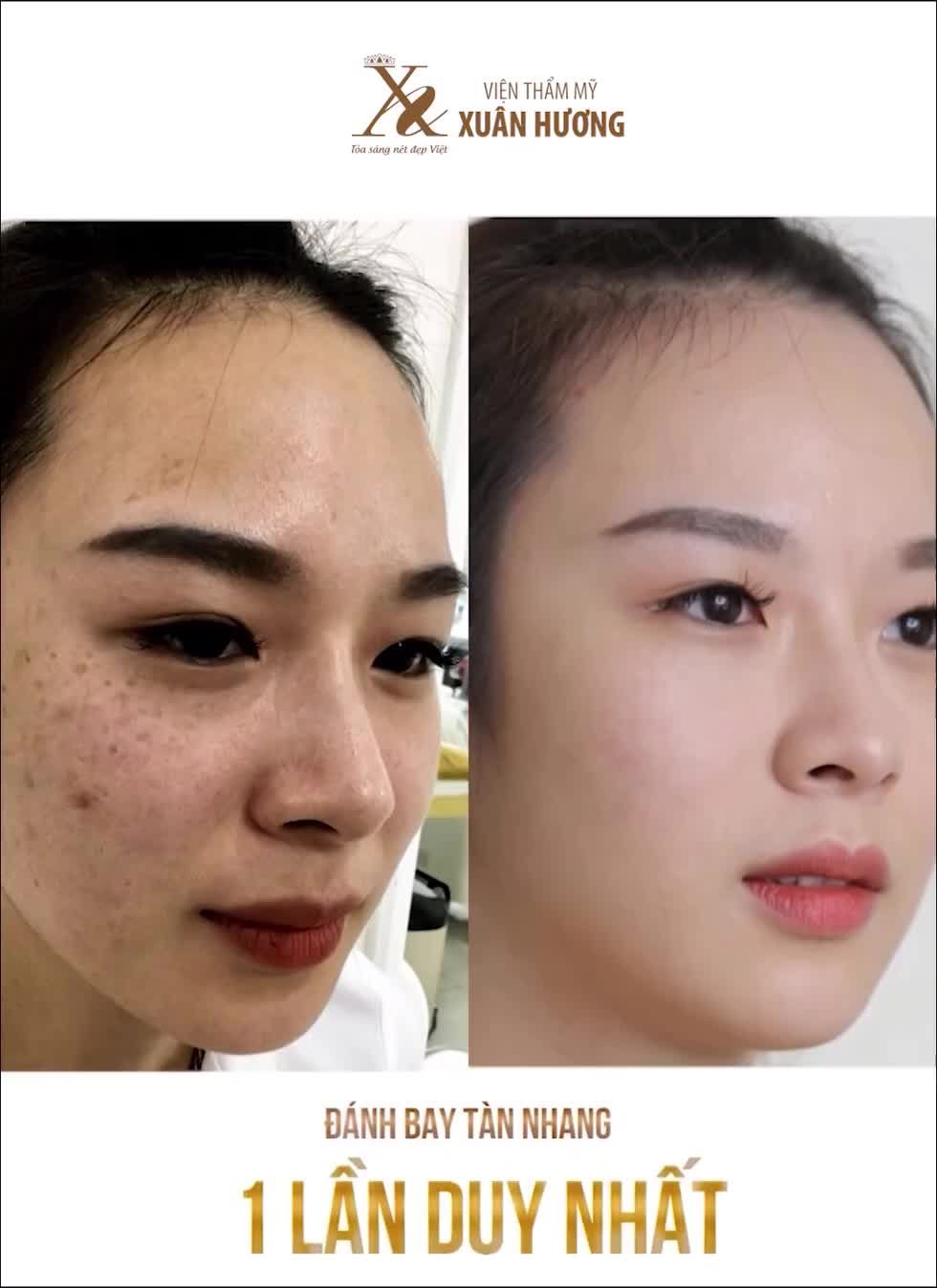 Nếu nám tàn nhang chính là nỗi lo của bạn thì hãy để VTM Xuân Hương "giải quyết"