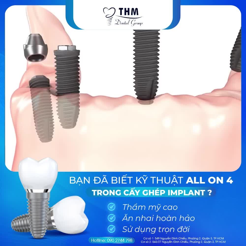 BẠN ĐÃ BIẾT KỸ THUẬT ALL ON 4 TRONG CẤY GHÉP IMPLANT?